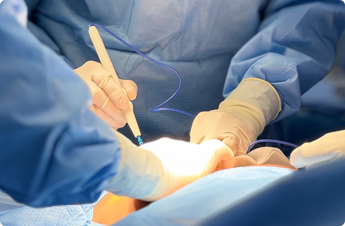 Imagen de cirugía de revisión